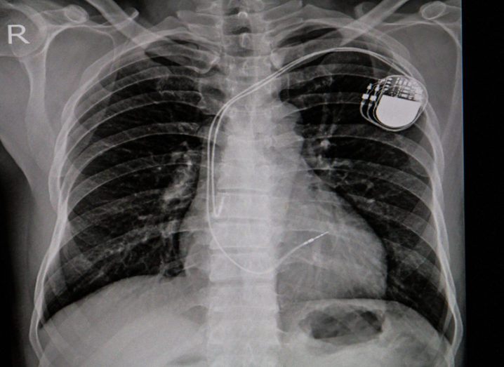 Pacemaker implant