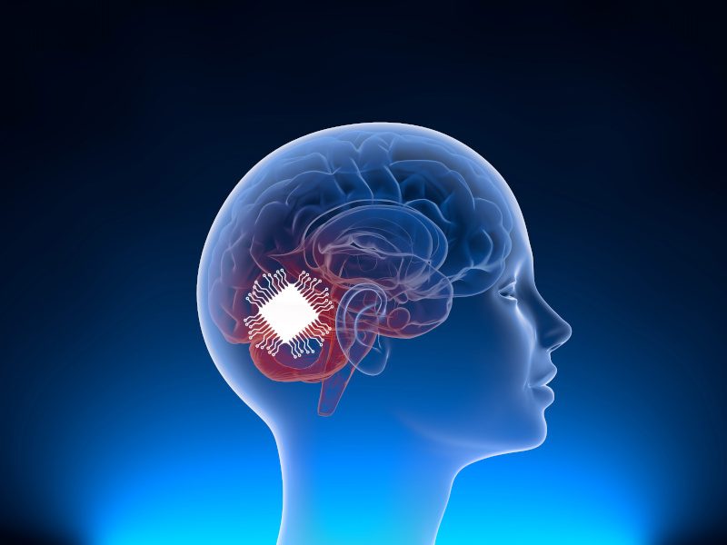 An illustration of a person's head with a brain-implant device in their head. Used for the context of Neuralink and its second human patient.