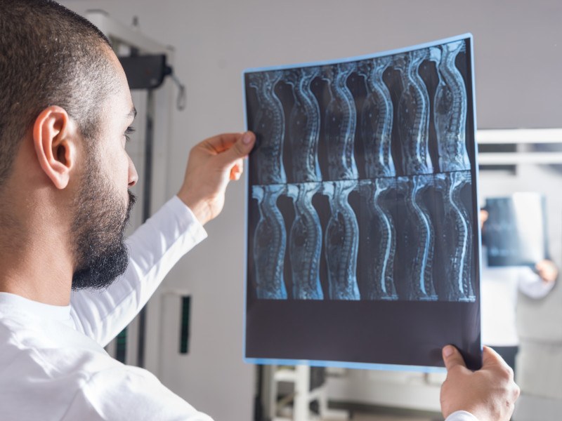 Doctor holding an x-ray of a spinal cord injury in his hands.